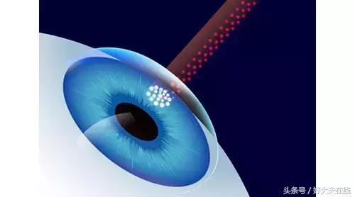 老年人做近视眼手术靠谱吗,4种近视手术哪种好