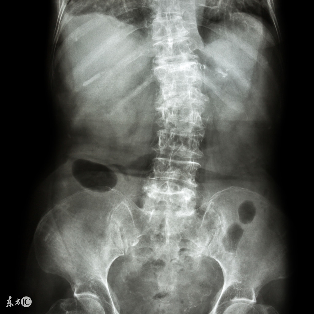 强直性脊柱炎吃什么东西好,强直性脊柱炎的饮食