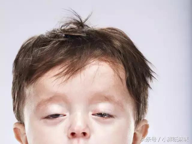 鬼脸儿综合症,鬼脸综合征怎么补救