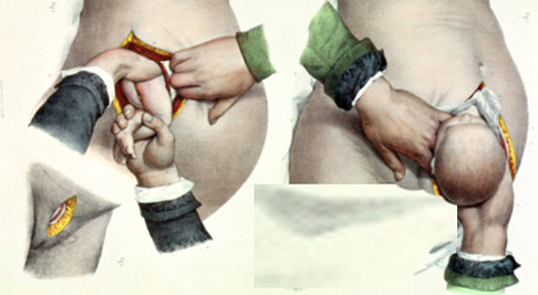 剖腹产竖切刀口比横切刀口恢复慢,产前一定要知道什么