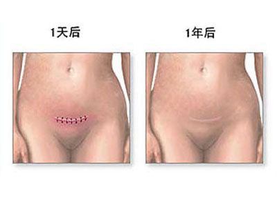 剖腹产全过程,剖腹产20天伤口真实照片