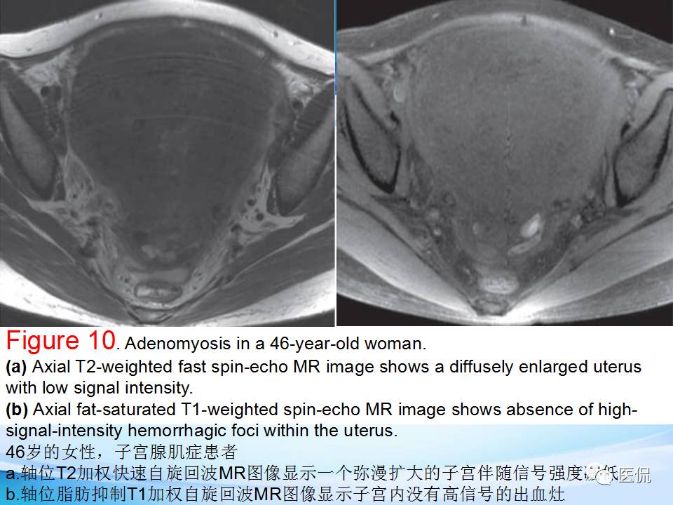 双语PPT：子宫腺肌症常见和不常见的MRI表现医学影像