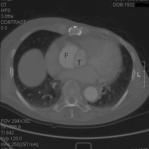 主动脉夹层袭来的恐慌,你不懂