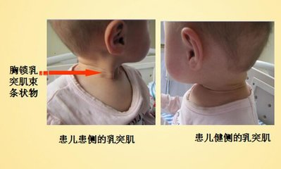 新生儿先天性肌性斜颈嘴巴是歪的,宝宝得了斜颈脖子歪怎么治