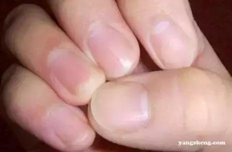 指甲出现哪些症状是有问题的,指甲上有皱纹有什么信号求救