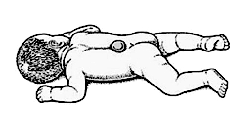 隐性脊柱裂尿床手术要多少费用,孩子隐匿性脊柱裂有影响吗