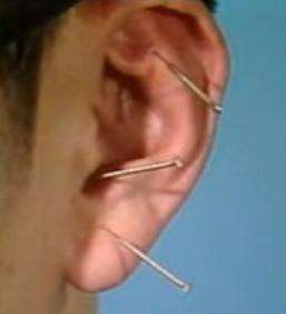 针灸怎样治疗高脂血症？