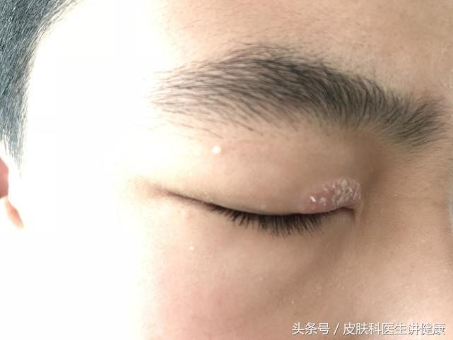 甲硝唑凝胶可以治神经性皮炎吗,神经性皮炎克林霉素甲硝唑