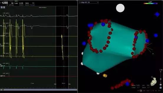 马长生房颤的最好治疗方法,马长生房颤消融后复发