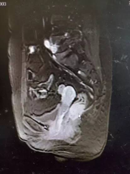 直肠神经内分泌肿瘤转移概率,直肠恶性肿瘤转移肝瘤严重吗