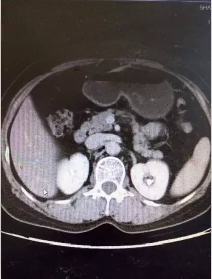 直肠神经内分泌肿瘤转移概率,直肠恶性肿瘤转移肝瘤严重吗