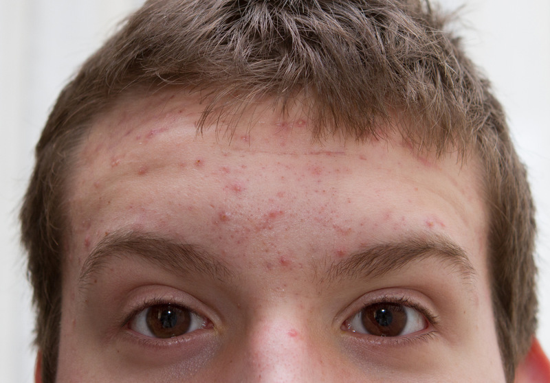 温和安全的祛痘产品有哪些,祛痘化妆品哪种好点用得快