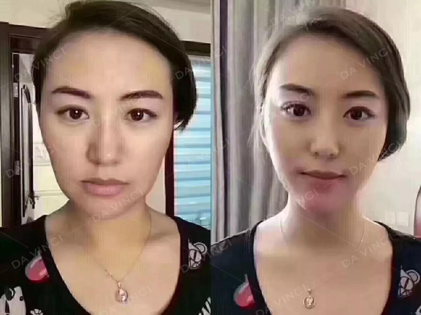 线雕提升的效果图,线雕青春定格术多久消肿