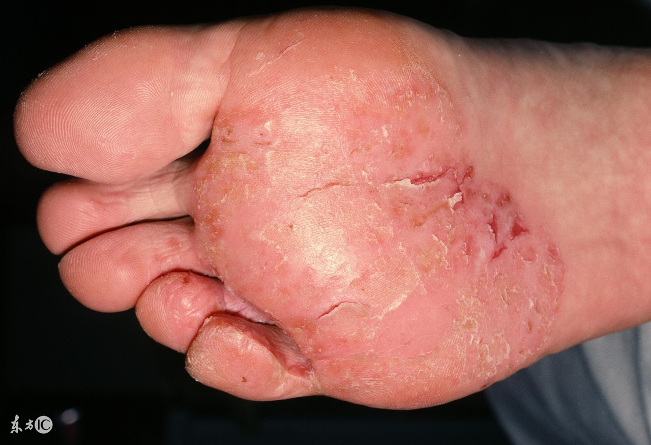 糜烂性胃窦炎饮食要注意什么,糜烂型脚气有哪些需要注意的