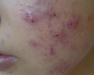 皮肤科痤疮治疗方法,皮肤科医生怎么祛痤疮