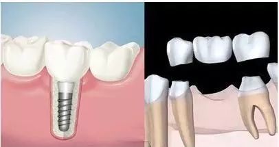 多颗牙缺失做烤瓷牙还是种植牙好,牙齿缺失是种植牙好还是烤瓷牙好