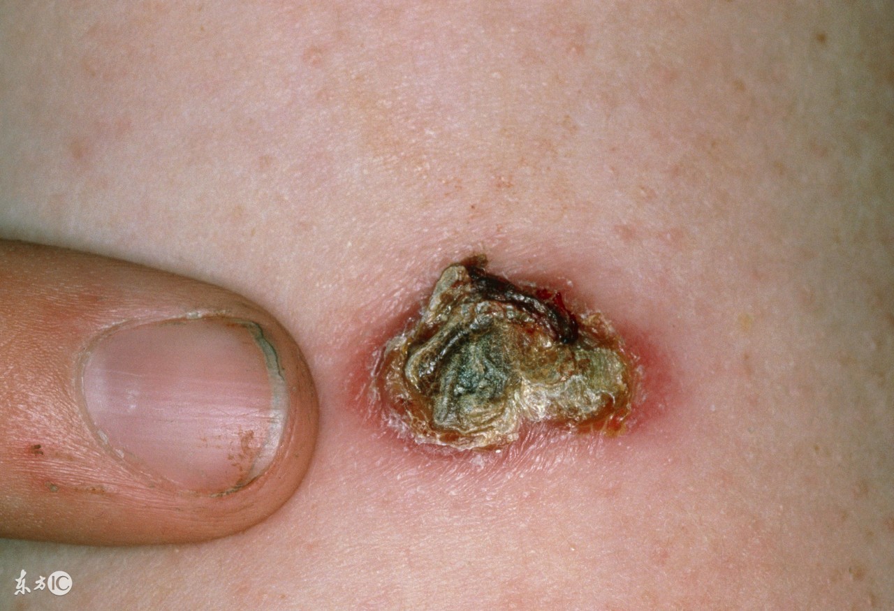 卡介苗化脓后洗澡弄破了怎么办,打卡介苗化脓破了之后怎么处理