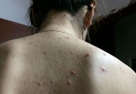 后背经常起疙瘩痘痘怎么回事,后背皮肤会长疙瘩