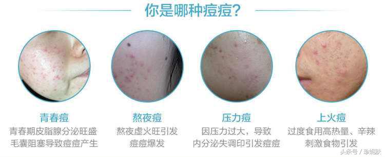 痘印持久不消用什么最好,痘印久久不消是怎么回事