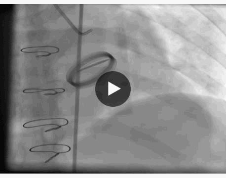 病例分享:服用华法林的月经期女性发生急性心肌梗死1例