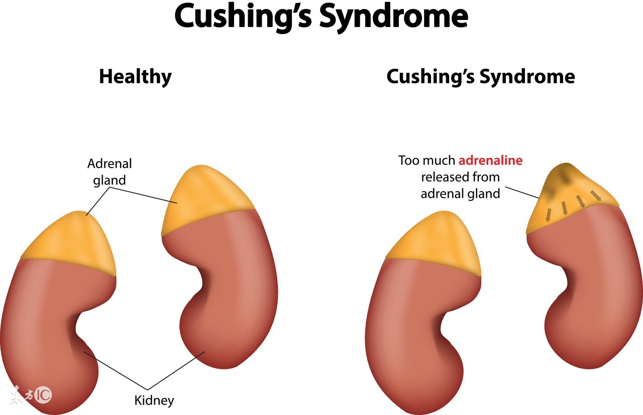 反复低钠血症考虑什么疾病,低钾性周期性瘫痪有效治疗