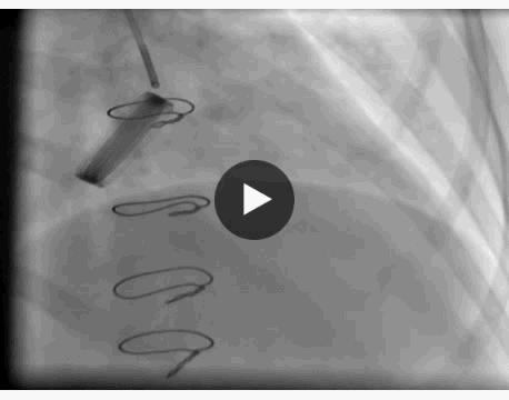 病例分享:服用华法林的月经期女性发生急性心肌梗死1例