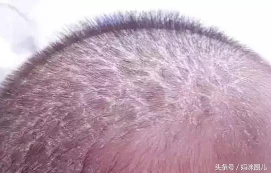 宝宝额头上的乳痂怎么去掉,新生儿脸上奶痂怎么消除
