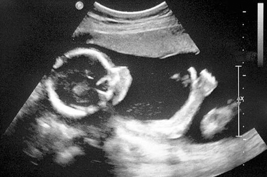 准妈妈看过来孕期瑜伽,孕期b超知识大全