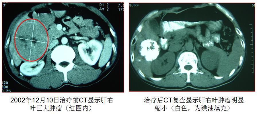 癌症患者治愈后怎么注意饮食,癌症病人康复一期时间怎么饮食