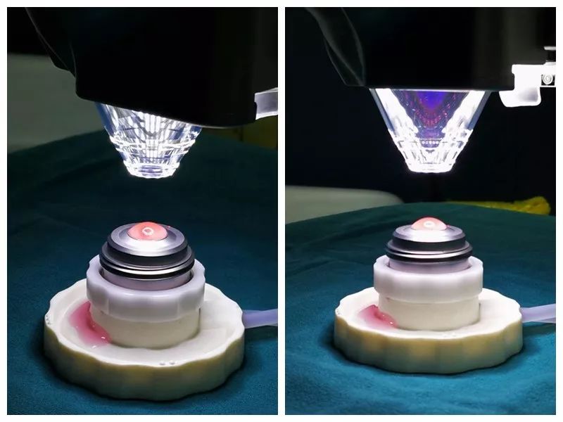 在小小眼球上，三台手术同时进行，不服不行！