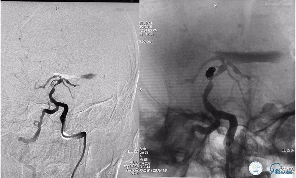 脑动脉瘤并颈动脉狭窄怎么治疗,脑动脉血管狭窄介入治疗效果好吗