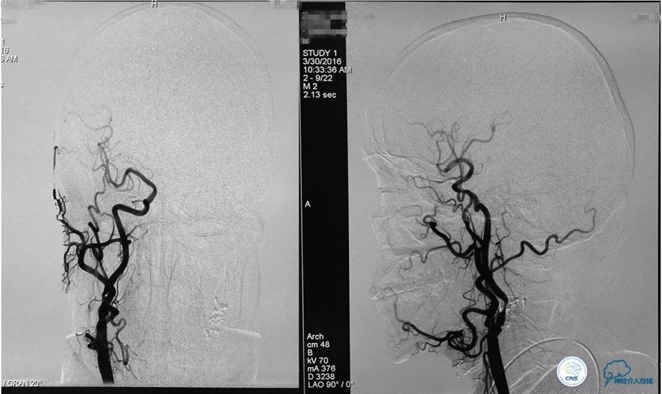脑动脉瘤并颈动脉狭窄怎么治疗,脑动脉血管狭窄介入治疗效果好吗