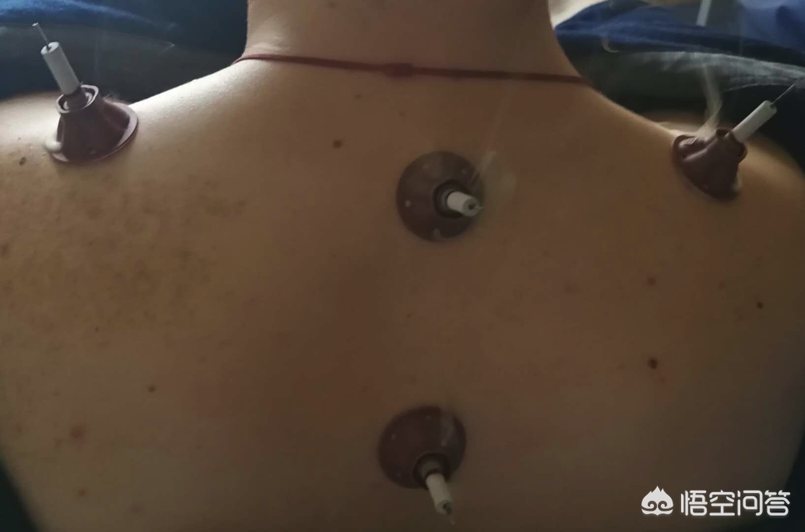 面瘫面神经炎最有效的方法,治疗周围神经性面瘫的土方