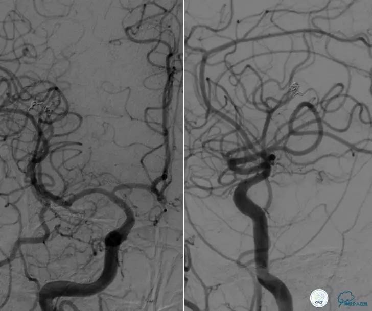 颅内动脉狭窄介入治疗研究,颅内血管cta副作用