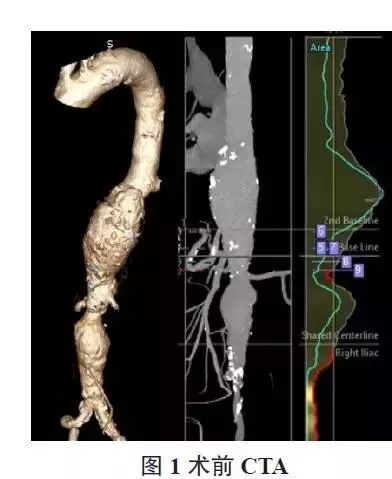 evar手术,胸主动脉夹层开窗手术