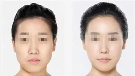 「爱美」双眼之间“一片荒芜”,鼻子一塌毁所有啊!