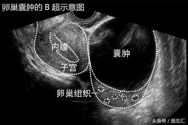 肚子隐隐疼是卵巢囊肿发作了吗,卵巢囊肿破裂出血怎么治疗