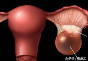 肚子隐隐疼是卵巢囊肿发作了吗,卵巢囊肿破裂出血怎么治疗