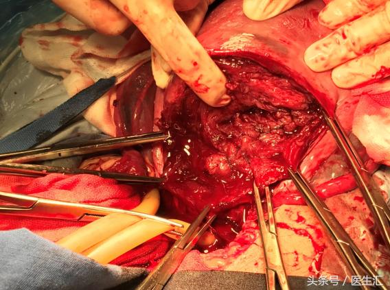 凶险性前置胎盘风险多大,孕28周臀位边缘性前置胎盘