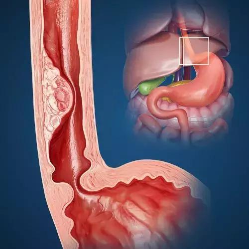 食管癌术后饮食宣教视频,食管癌手术术前一天饮食