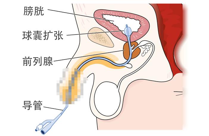 插三个月尿管拔了排尿的最快方法,拔完尿管出现小便不受控制怎么办