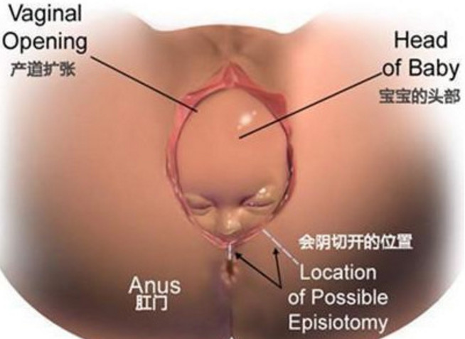 女人怕顺产侧切,为什么有的女的觉得顺产很丢人