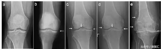滑膜炎是肌肉还是骨头的问题,滑膜炎是不是类风湿的一种