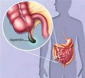 阑尾微创手术后发热,阑尾手术后发热是什么原因引起的