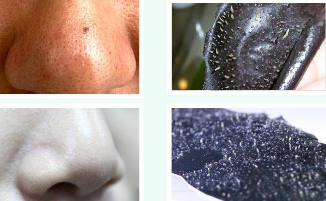 鼻尖黑头严重是什么原因,鼻尖上有黑头是怎么回事