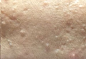 脸上不断的长痘痘和闭合性粉刺,青少年脸上的闭合性粉刺能不能挤