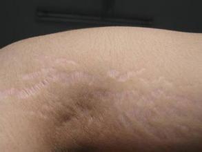 不要滥用激素药,哪种疾病禁用糖皮质激素类药物