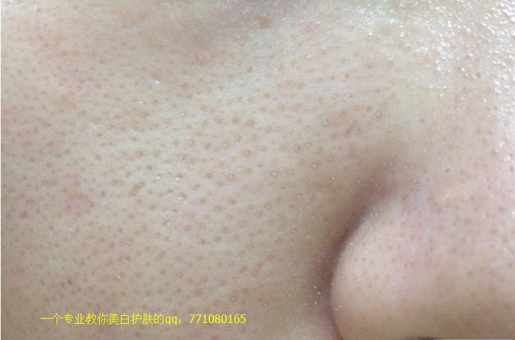 白头粉刺怎么去除鼻子脸颊,白头粉刺怎么去除背部