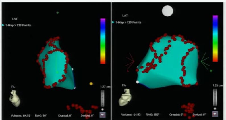 郑大一附院心血管内科专家陈英伟,房颤的治疗策略及进展