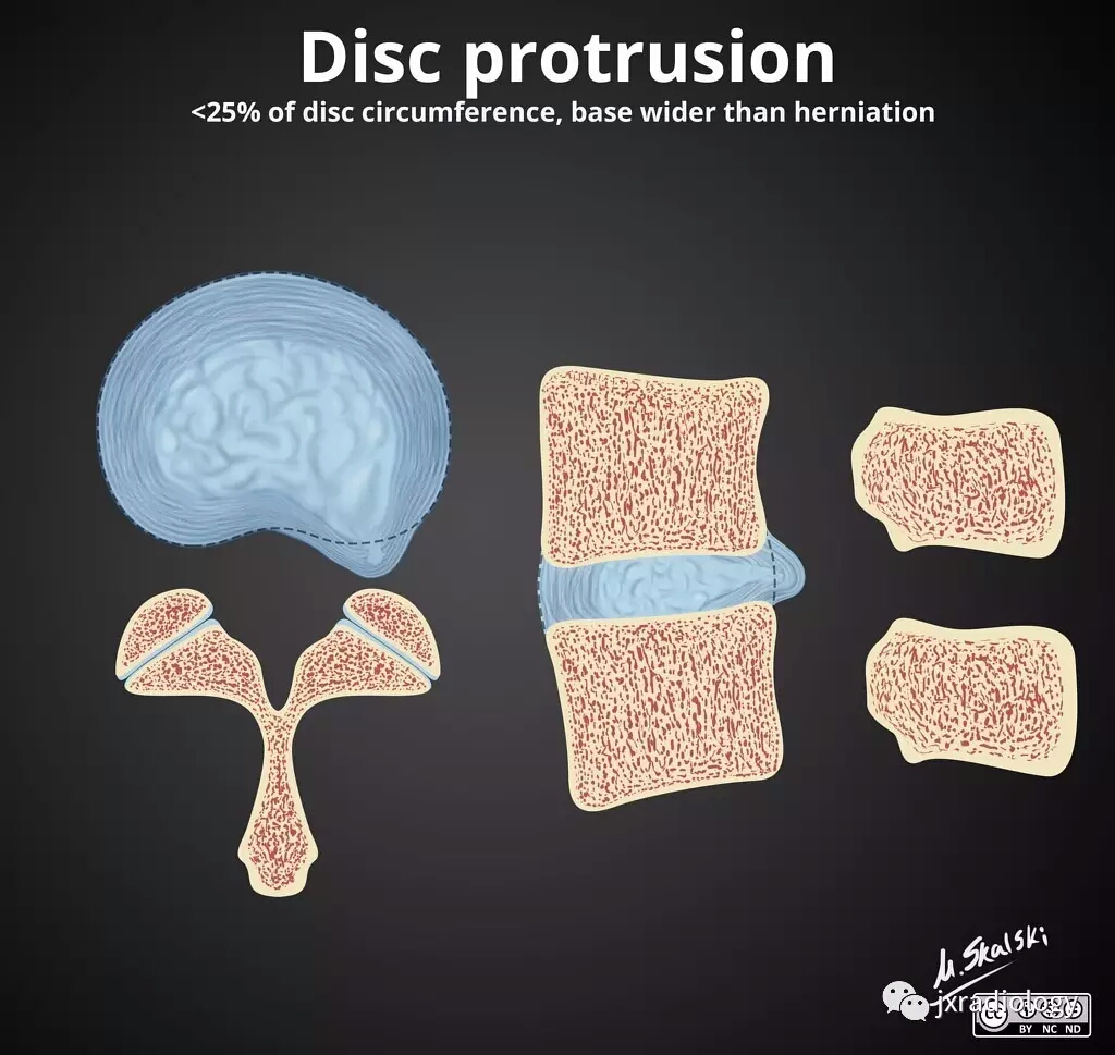 腰椎间盘怎么判断膨出还是突出,腰椎间盘膨出的最佳锻炼方法图